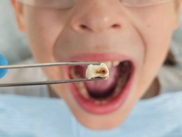 Best Emergency Dentist for Knocked-Out Tooth in Balch Springs, TX